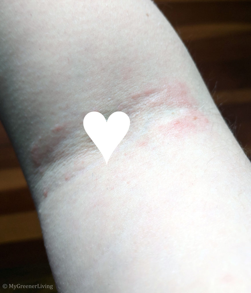 photo showing rectangular patch of contact dermatitis from medical tape